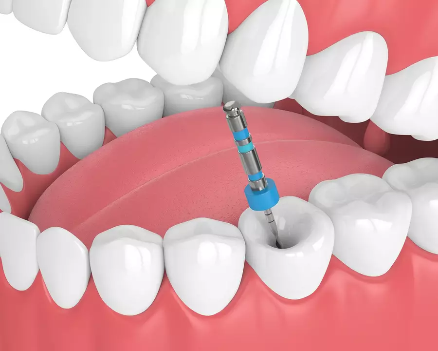 How Prophylaxis Can Help Prevent the Need for Root Canal Treatment